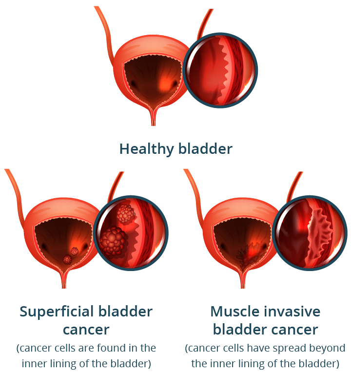 bladder cancer mobile 0fb570 (1)